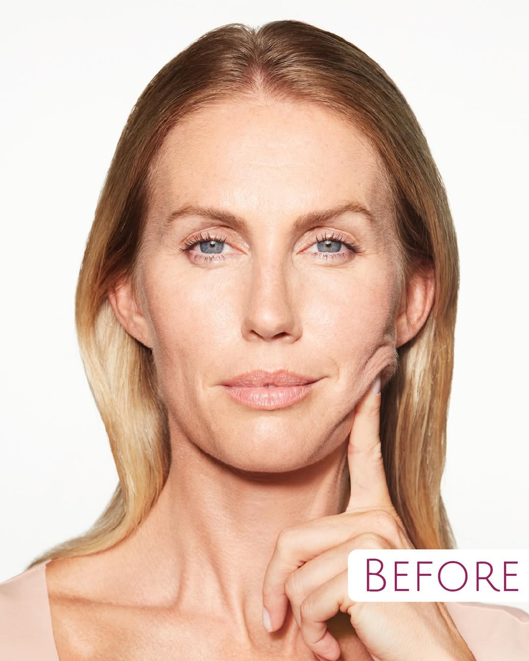 Sculptra® gives fast, progressive and sustained results. Patients and injectors have reported sk (1) Sculptra® gives fast, progressive and sustained results. Patients and injectors have reported sk (1)
