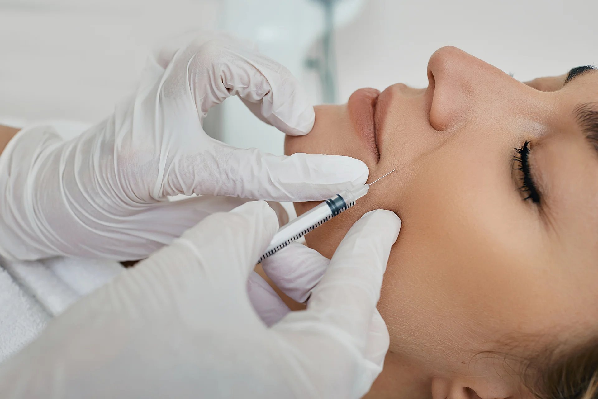 Close-up of softer smile lines after nasolabial fold filler in Oakville