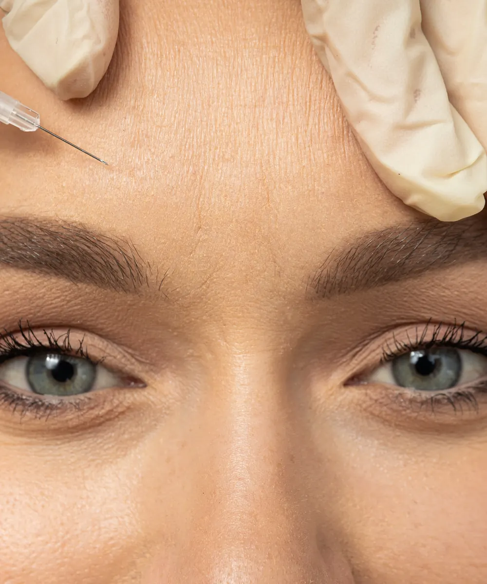Botox being injected into the forehead to soften horizontal lines in Oakville