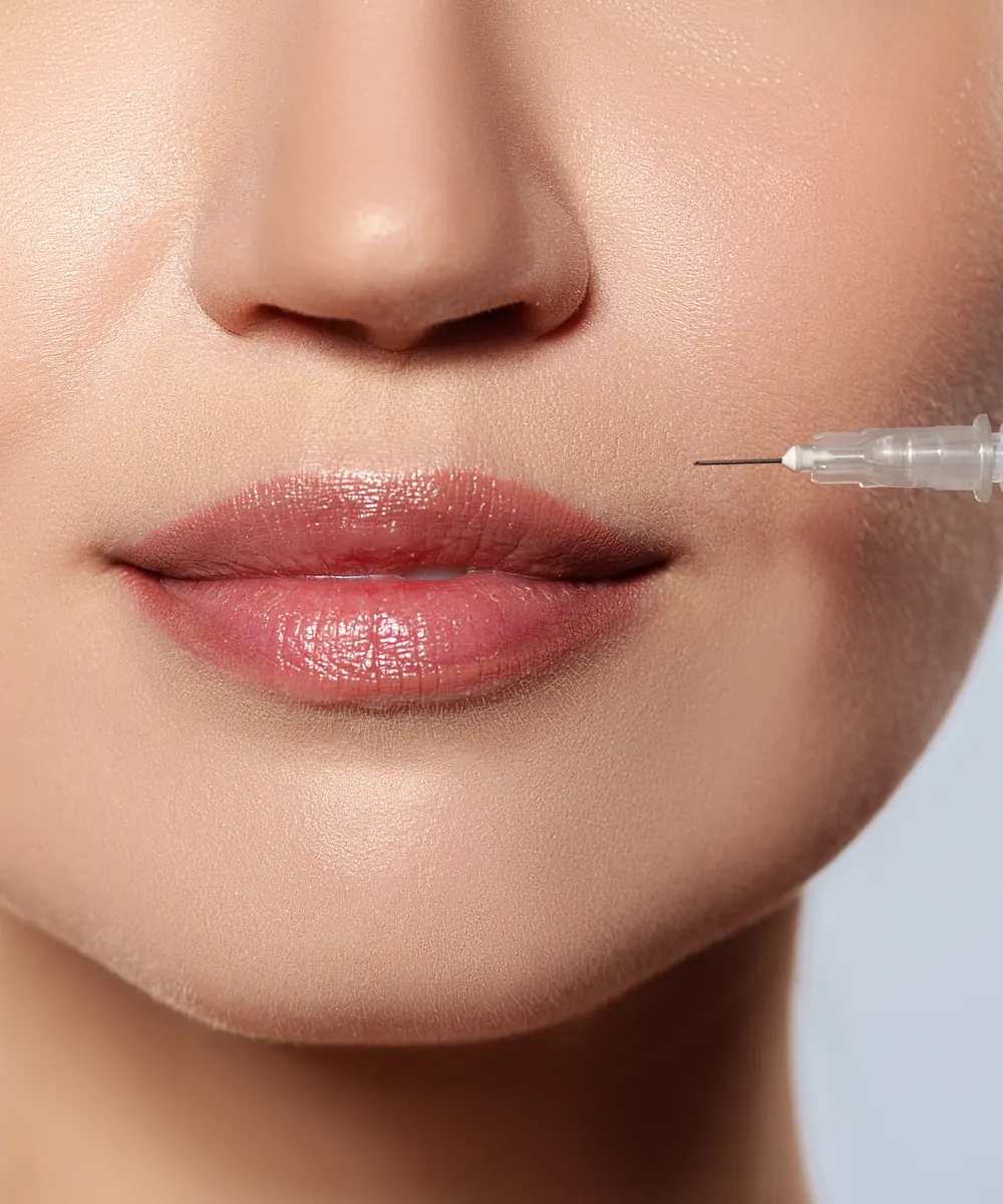 Botox being injected at the upper lip to soften a gummy smile in Oakville