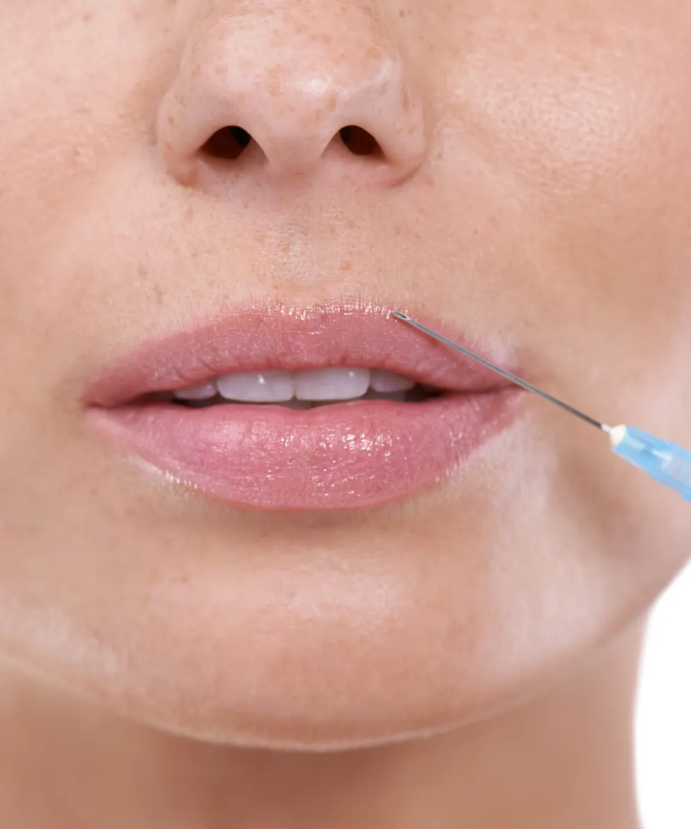 Small Botox injection at the upper lip border for a lip flip in Oakville