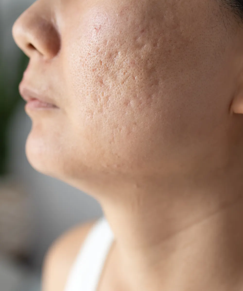 Close view of a woman's cheek and jaw showing shallow textured acne scarring in soft light