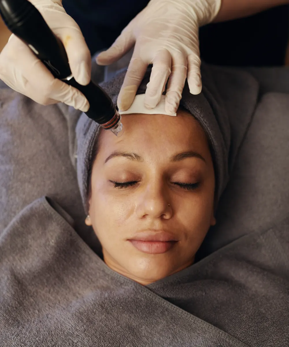 Gloved hands move a pen style microneedling device across a relaxed woman's forehead